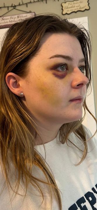 Ciara’s injuries after her then boyfriend James Maheady kicked her in the face following an argument at Christmas last year